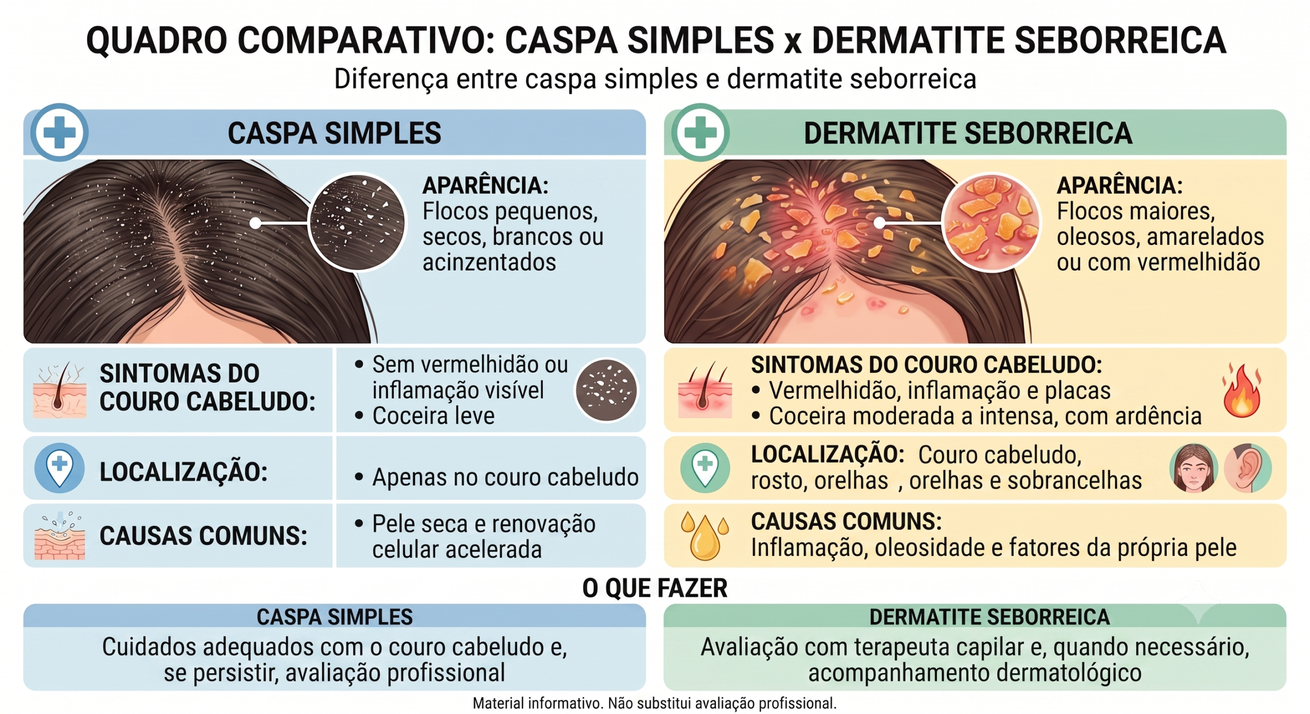Diferença entre caspa simples e dermatite seborreica